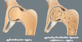 diagnosis-of-osteoporosis-its-treatment-and-preventive-tips-for-strong-bones