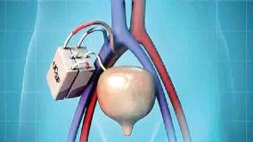 artificial-kidney