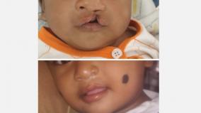 pediatric-lip-and-palate-can-be-repaired-at-an-early-stage-successful-treatment-for-77-children-at-coimbatore-government-hospital