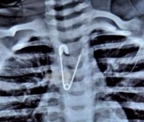 safety-pin-trapped-in-baby-esophagus-coimbatore-government-hospital-doctors-take-out-safely