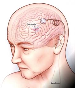 parkinsons-disease