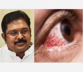 government-of-tamil-nadu-should-take-serious-action-to-control-black-fungus-ttv-dinakaran-insists