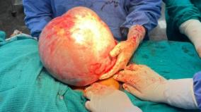 7-kg-tumor-in-the-stomach