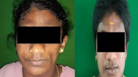 45-year-old-face-appearance-for-20-year-old-girl-coimbatore-government-hospital-doctors-operated-successfully