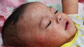 measles-increased-by-76-percent