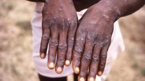 monkeypox-92-person-infected-in-12-countries-who
