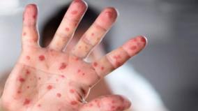 the-spread-of-monkeypox-disease-panic-is-not-required-attention-is-enough