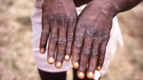 no-monkeypox-in-india-union-health-department-officials-informed