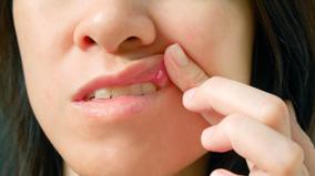 what-is-the-way-to-prevent-mouth-ulcers-consult-a-doctor
