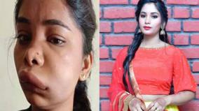kannada-actress-swathi-sathish-swollen-face-after-taking-treatment-for-tooth