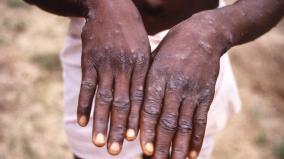 symptoms-and-prevention-of-monkeypox