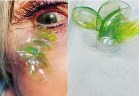 doctor-removing-23-contact-lenses-from-patient-s-eye