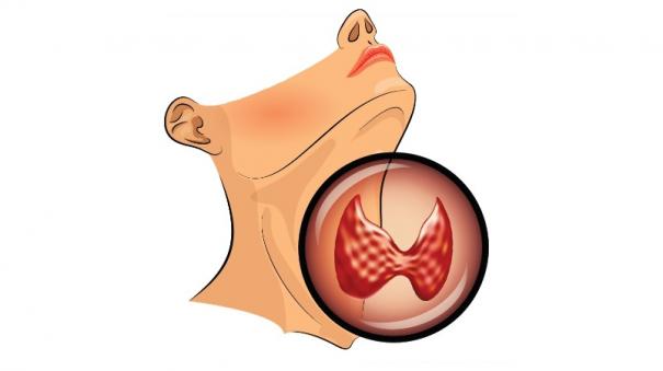 Thyroid hormone disorder