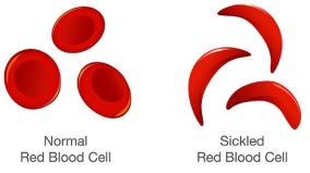 sickle-cell-anemia-diagnosis-and-treatment