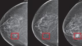 ai-successfully-diagnoses-breast-cancer-years-before-it-develops