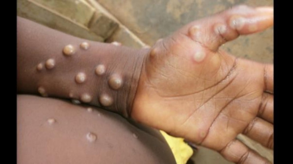 monkeypox-symptoms-in-young-man-who-returned-from-singapore-to-pudukottai