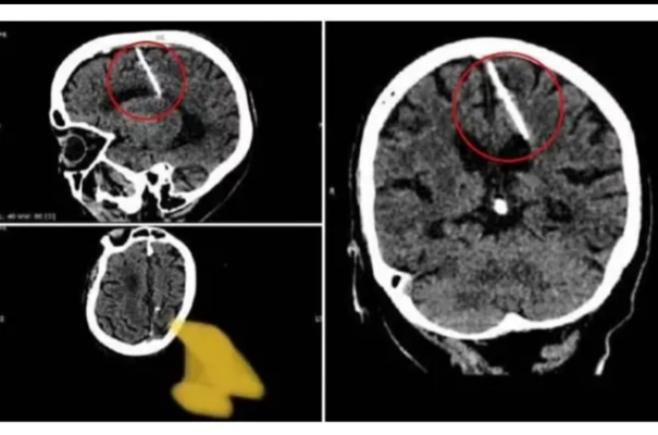 80-year-old-woman-with-a-three-inch-nail-in-her-brain