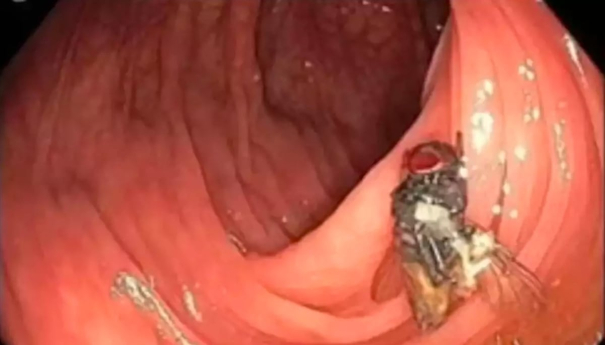 inside-of-human-intestine-doctors-found-fly