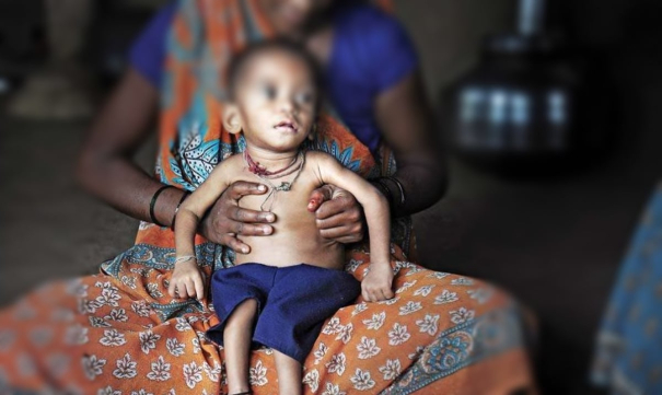 due-to-malnutrition-huge-children-affected-in-gujarat