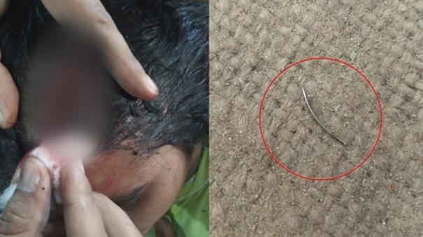 doctor-at-up-hospital-forgets-surgical-needle-inside-woman-head